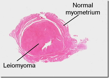 uterus whorled ovary disorders appearance circumscription sharp